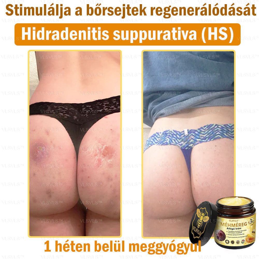 VLSVLS™ Méhméreg Átfogó Krém (Minden korosztály számára alkalmas & HSME ajánlja)👍✅✅✅
