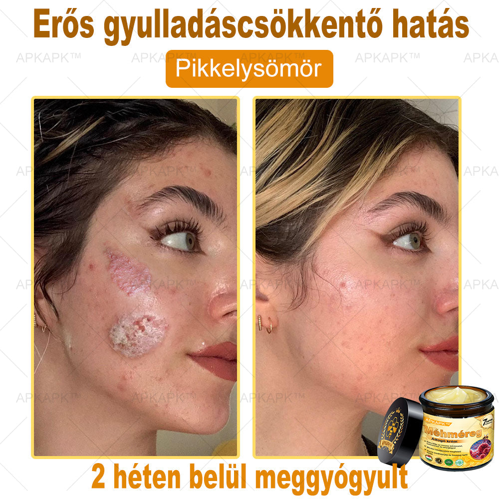𝐀𝐏𝐊𝐀𝐏𝐊™ 𝐌É𝐇𝐌É𝐑𝐄𝐆 Á𝐓𝐅𝐎𝐆Ó 𝐊𝐑É𝐌🥇𝐀 𝐛ö𝐫𝐩𝐫𝐨𝐛𝐥é𝐦á𝐤 𝐤𝐞𝐳𝐞𝐥é𝐬𝐞 𝐦𝐚𝐠á𝐛𝐚𝐧 𝐟𝐨𝐠𝐥𝐚𝐥𝐣𝐚: é𝐥𝐞𝐭𝐤𝐨𝐫𝐢 𝐟𝐨𝐥𝐭𝐨𝐤, 𝐡𝐞𝐠𝐞𝐤, 𝐬𝐳𝐞𝐦ö𝐥𝐜𝐬ö𝐤, 𝐛ö𝐫𝐧ö𝐯𝐞𝐝é𝐤𝐞𝐤, 𝐭á𝐥𝐲𝐨𝐠𝐨𝐤, 𝐩𝐚𝐭𝐭𝐚𝐧á𝐬𝐨𝐤, 𝐞𝐤𝐜é𝐦𝐚, 𝐩𝐬𝐨𝐫𝐢𝐚𝐬𝐢𝐬, 𝐚𝐜𝐧𝐞 𝐢𝐧𝐯𝐞𝐫𝐬𝐚, 𝐫á𝐧𝐜𝐨𝐤, 𝐛ö𝐫ö𝐫𝐞𝐠𝐞𝐝é𝐬 é𝐬 𝐞𝐠𝐲é𝐛 𝐩𝐫𝐨𝐛𝐥é𝐦á𝐤🔥