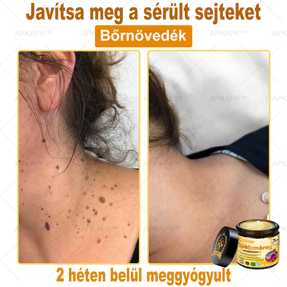 𝐀𝐏𝐊𝐀𝐏𝐊™ 𝐌É𝐇𝐌É𝐑𝐄𝐆 Á𝐓𝐅𝐎𝐆Ó 𝐊𝐑É𝐌🥇𝐀 𝐛ö𝐫𝐩𝐫𝐨𝐛𝐥é𝐦á𝐤 𝐤𝐞𝐳𝐞𝐥é𝐬𝐞 𝐦𝐚𝐠á𝐛𝐚𝐧 𝐟𝐨𝐠𝐥𝐚𝐥𝐣𝐚: é𝐥𝐞𝐭𝐤𝐨𝐫𝐢 𝐟𝐨𝐥𝐭𝐨𝐤, 𝐡𝐞𝐠𝐞𝐤, 𝐬𝐳𝐞𝐦ö𝐥𝐜𝐬ö𝐤, 𝐛ö𝐫𝐧ö𝐯𝐞𝐝é𝐤𝐞𝐤, 𝐭á𝐥𝐲𝐨𝐠𝐨𝐤, 𝐩𝐚𝐭𝐭𝐚𝐧á𝐬𝐨𝐤, 𝐞𝐤𝐜é𝐦𝐚, 𝐩𝐬𝐨𝐫𝐢𝐚𝐬𝐢𝐬, 𝐚𝐜𝐧𝐞 𝐢𝐧𝐯𝐞𝐫𝐬𝐚, 𝐫á𝐧𝐜𝐨𝐤, 𝐛ö𝐫ö𝐫𝐞𝐠𝐞𝐝é𝐬 é𝐬 𝐞𝐠𝐲é𝐛 𝐩𝐫𝐨𝐛𝐥é𝐦á𝐤🔥