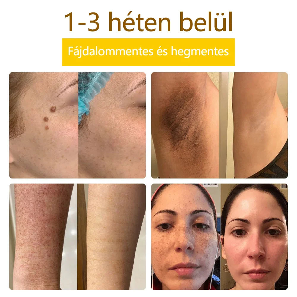 ✅flysmus™ méhméreg kezelő krém🐝: Ekcéma, pikkelysömör, akne, rosacea, gombás fertőzések, szemölcsök kezelése