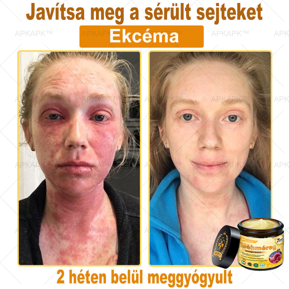 𝐀𝐏𝐊𝐀𝐏𝐊™ 𝐌É𝐇𝐌É𝐑𝐄𝐆 Á𝐓𝐅𝐎𝐆Ó 𝐊𝐑É𝐌🥇𝐀 𝐛ö𝐫𝐩𝐫𝐨𝐛𝐥é𝐦á𝐤 𝐤𝐞𝐳𝐞𝐥é𝐬𝐞 𝐦𝐚𝐠á𝐛𝐚𝐧 𝐟𝐨𝐠𝐥𝐚𝐥𝐣𝐚: é𝐥𝐞𝐭𝐤𝐨𝐫𝐢 𝐟𝐨𝐥𝐭𝐨𝐤, 𝐡𝐞𝐠𝐞𝐤, 𝐬𝐳𝐞𝐦ö𝐥𝐜𝐬ö𝐤, 𝐛ö𝐫𝐧ö𝐯𝐞𝐝é𝐤𝐞𝐤, 𝐭á𝐥𝐲𝐨𝐠𝐨𝐤, 𝐩𝐚𝐭𝐭𝐚𝐧á𝐬𝐨𝐤, 𝐞𝐤𝐜é𝐦𝐚, 𝐩𝐬𝐨𝐫𝐢𝐚𝐬𝐢𝐬, 𝐚𝐜𝐧𝐞 𝐢𝐧𝐯𝐞𝐫𝐬𝐚, 𝐫á𝐧𝐜𝐨𝐤, 𝐛ö𝐫ö𝐫𝐞𝐠𝐞𝐝é𝐬 é𝐬 𝐞𝐠𝐲é𝐛 𝐩𝐫𝐨𝐛𝐥é𝐦á𝐤🔥