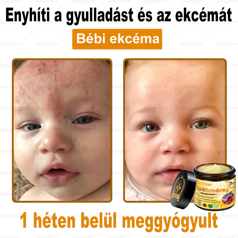 𝐀𝐏𝐊𝐀𝐏𝐊™ 𝐌É𝐇𝐌É𝐑𝐄𝐆 Á𝐓𝐅𝐎𝐆Ó 𝐊𝐑É𝐌🥇𝐀 𝐛ö𝐫𝐩𝐫𝐨𝐛𝐥é𝐦á𝐤 𝐤𝐞𝐳𝐞𝐥é𝐬𝐞 𝐦𝐚𝐠á𝐛𝐚𝐧 𝐟𝐨𝐠𝐥𝐚𝐥𝐣𝐚: é𝐥𝐞𝐭𝐤𝐨𝐫𝐢 𝐟𝐨𝐥𝐭𝐨𝐤, 𝐡𝐞𝐠𝐞𝐤, 𝐬𝐳𝐞𝐦ö𝐥𝐜𝐬ö𝐤, 𝐛ö𝐫𝐧ö𝐯𝐞𝐝é𝐤𝐞𝐤, 𝐭á𝐥𝐲𝐨𝐠𝐨𝐤, 𝐩𝐚𝐭𝐭𝐚𝐧á𝐬𝐨𝐤, 𝐞𝐤𝐜é𝐦𝐚, 𝐩𝐬𝐨𝐫𝐢𝐚𝐬𝐢𝐬, 𝐚𝐜𝐧𝐞 𝐢𝐧𝐯𝐞𝐫𝐬𝐚, 𝐫á𝐧𝐜𝐨𝐤, 𝐛ö𝐫ö𝐫𝐞𝐠𝐞𝐝é𝐬 é𝐬 𝐞𝐠𝐲é𝐛 𝐩𝐫𝐨𝐛𝐥é𝐦á𝐤🔥