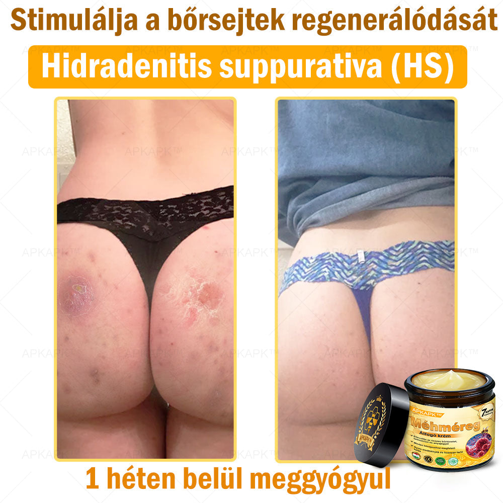 𝐀𝐏𝐊𝐀𝐏𝐊™ 𝐌É𝐇𝐌É𝐑𝐄𝐆 Á𝐓𝐅𝐎𝐆Ó 𝐊𝐑É𝐌🥇𝐀 𝐛ö𝐫𝐩𝐫𝐨𝐛𝐥é𝐦á𝐤 𝐤𝐞𝐳𝐞𝐥é𝐬𝐞 𝐦𝐚𝐠á𝐛𝐚𝐧 𝐟𝐨𝐠𝐥𝐚𝐥𝐣𝐚: é𝐥𝐞𝐭𝐤𝐨𝐫𝐢 𝐟𝐨𝐥𝐭𝐨𝐤, 𝐡𝐞𝐠𝐞𝐤, 𝐬𝐳𝐞𝐦ö𝐥𝐜𝐬ö𝐤, 𝐛ö𝐫𝐧ö𝐯𝐞𝐝é𝐤𝐞𝐤, 𝐭á𝐥𝐲𝐨𝐠𝐨𝐤, 𝐩𝐚𝐭𝐭𝐚𝐧á𝐬𝐨𝐤, 𝐞𝐤𝐜é𝐦𝐚, 𝐩𝐬𝐨𝐫𝐢𝐚𝐬𝐢𝐬, 𝐚𝐜𝐧𝐞 𝐢𝐧𝐯𝐞𝐫𝐬𝐚, 𝐫á𝐧𝐜𝐨𝐤, 𝐛ö𝐫ö𝐫𝐞𝐠𝐞𝐝é𝐬 é𝐬 𝐞𝐠𝐲é𝐛 𝐩𝐫𝐨𝐛𝐥é𝐦á𝐤🔥