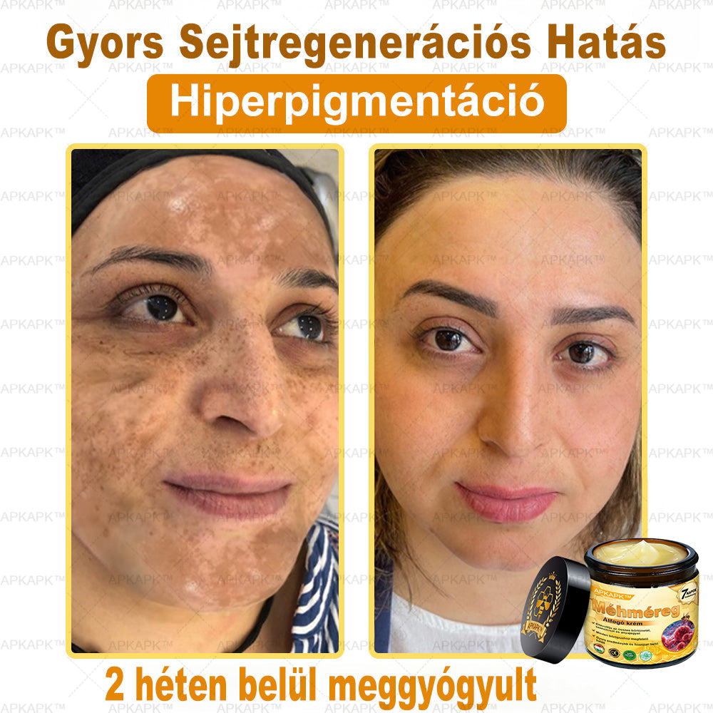 𝐀𝐏𝐊𝐀𝐏𝐊™ 𝐌É𝐇𝐌É𝐑𝐄𝐆 Á𝐓𝐅𝐎𝐆Ó 𝐊𝐑É𝐌🥇𝐀 𝐛ö𝐫𝐩𝐫𝐨𝐛𝐥é𝐦á𝐤 𝐤𝐞𝐳𝐞𝐥é𝐬𝐞 𝐦𝐚𝐠á𝐛𝐚𝐧 𝐟𝐨𝐠𝐥𝐚𝐥𝐣𝐚: é𝐥𝐞𝐭𝐤𝐨𝐫𝐢 𝐟𝐨𝐥𝐭𝐨𝐤, 𝐡𝐞𝐠𝐞𝐤, 𝐬𝐳𝐞𝐦ö𝐥𝐜𝐬ö𝐤, 𝐛ö𝐫𝐧ö𝐯𝐞𝐝é𝐤𝐞𝐤, 𝐭á𝐥𝐲𝐨𝐠𝐨𝐤, 𝐩𝐚𝐭𝐭𝐚𝐧á𝐬𝐨𝐤, 𝐞𝐤𝐜é𝐦𝐚, 𝐩𝐬𝐨𝐫𝐢𝐚𝐬𝐢𝐬, 𝐚𝐜𝐧𝐞 𝐢𝐧𝐯𝐞𝐫𝐬𝐚, 𝐫á𝐧𝐜𝐨𝐤, 𝐛ö𝐫ö𝐫𝐞𝐠𝐞𝐝é𝐬 é𝐬 𝐞𝐠𝐲é𝐛 𝐩𝐫𝐨𝐛𝐥é𝐦á𝐤🔥