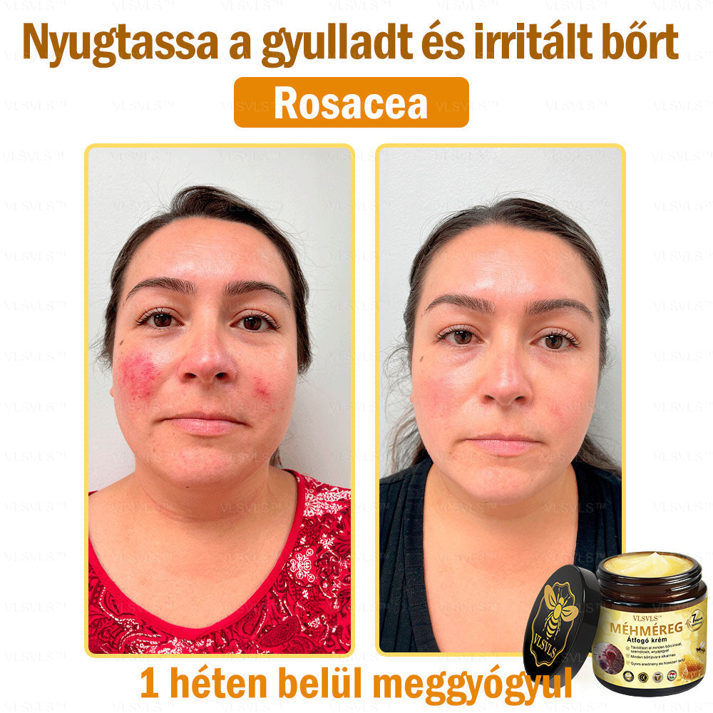 VLSVLS™ Méhméreg Átfogó Krém (Minden korosztály számára alkalmas & HSME ajánlja)👍✅