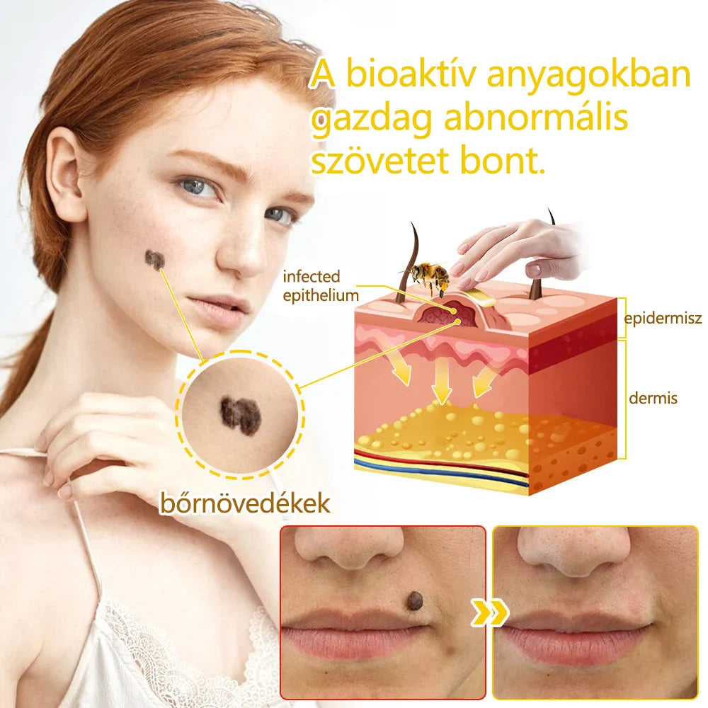 ✅flysmus™ méhméreg kezelő krém🐝: Ekcéma, pikkelysömör, akne, rosacea, gombás fertőzések, szemölcsök kezelése