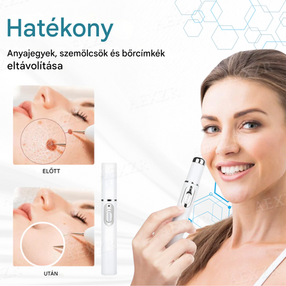 Bikenda® non-invazív anyajegy- és szemölcseltávolító lézertoll✨✨✨