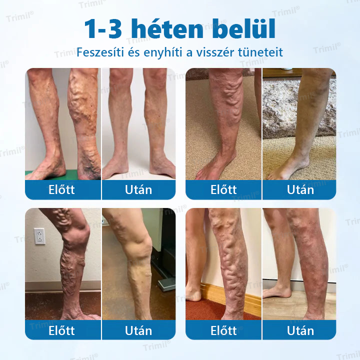 💚Trimil® VeinGuard Gyógynövényes Spray - ✅ Klinikailag bizonyított, hogy mindössze 7 nap alatt megszünteti a visszereket!💚💚💚