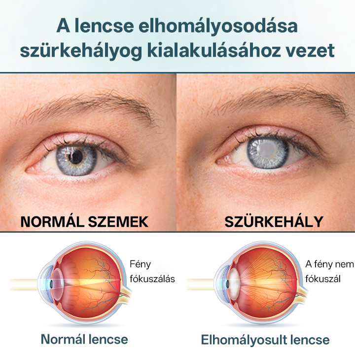 Timilk® OptiFusion Nano szemcsepp szérum🎉🎉🎉