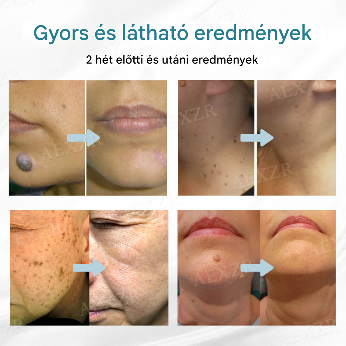 Bikenda® non-invazív anyajegy- és szemölcseltávolító lézertoll✨✨✨