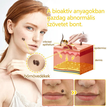 ✅flysmus™ méhméreg kezelő krém🐝: Ekcéma, pikkelysömör, akne, rosacea, gombás fertőzések, szemölcsök kezelése
