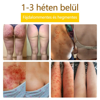 ✅flysmus™ méhméreg kezelő krém🐝: Ekcéma, pikkelysömör, akne, rosacea, gombás fertőzések, szemölcsök kezelése